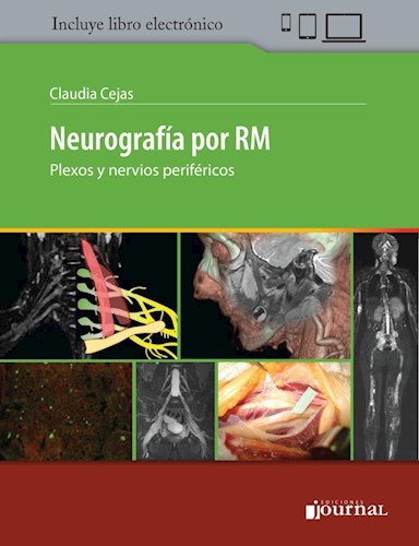 Neurografía por RM Plexos y nervios periféricos