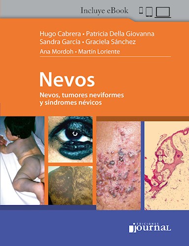 Nevos Nevos, tumores neviformes y síndromes névicos
