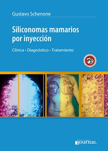 Siliconomas mamarios por inyección Clínica bb Diagnóstico   Tratamiento