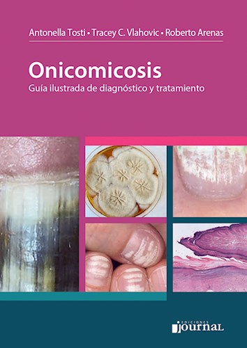 Onicomicosis Guía ilustrada de diagnóstico y tratamiento