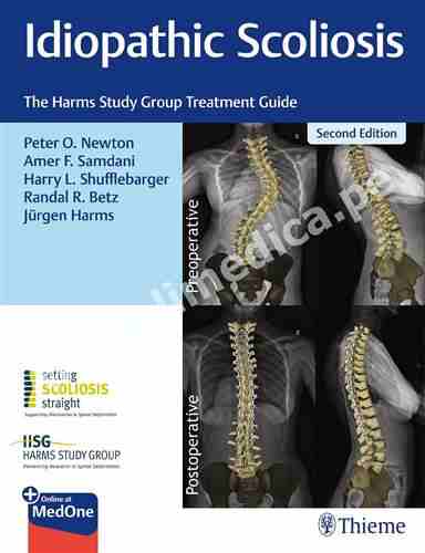 Idiopathic Scoliosis The Harms Study Group Treatment Guide